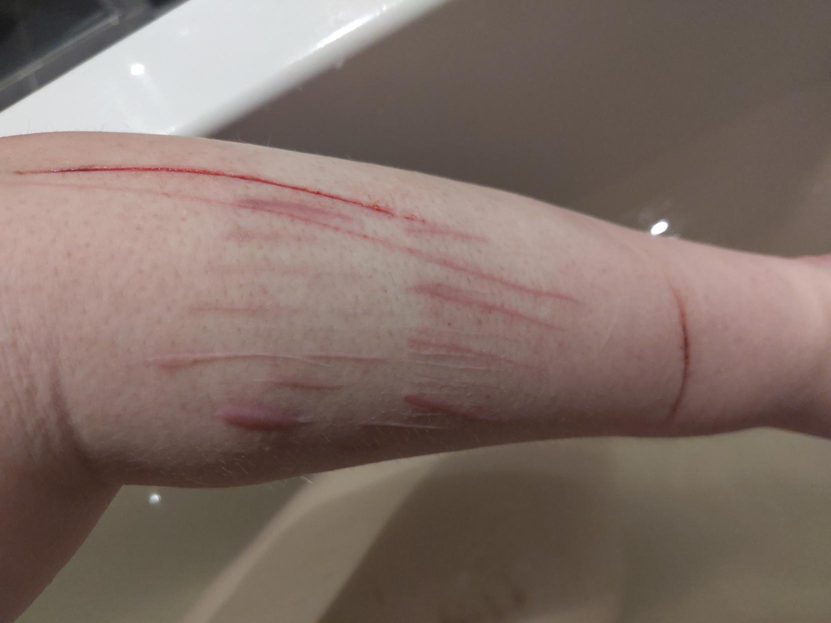 A picture of my lower left arm taken in a bathtub. It is covered in scars and has one long and one very long open cut